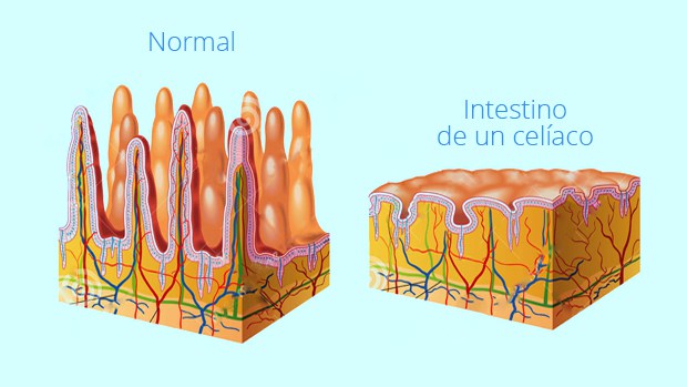 biopsia-celiaquia-celiaco-prueba1-e1494798719585