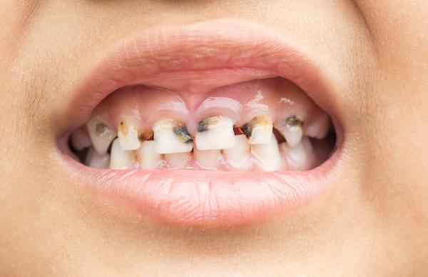 00341-buoh-open-mouth-with-decaying-teeth-inline