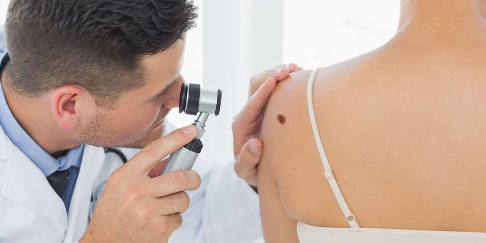 melanoma