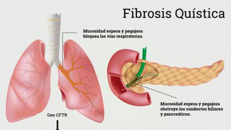 fibrosis-quistica-0